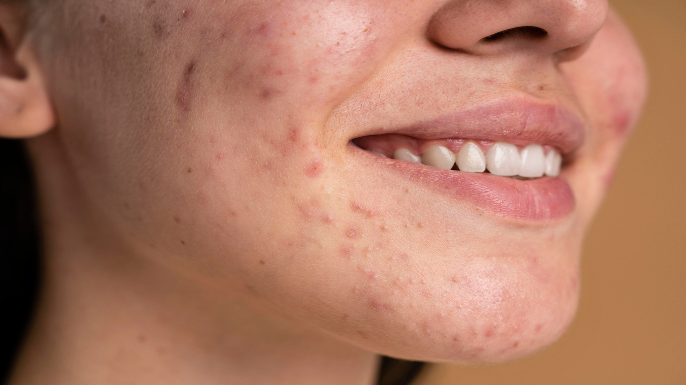 imagem de uma moça sorrindo com acne na fase adulta